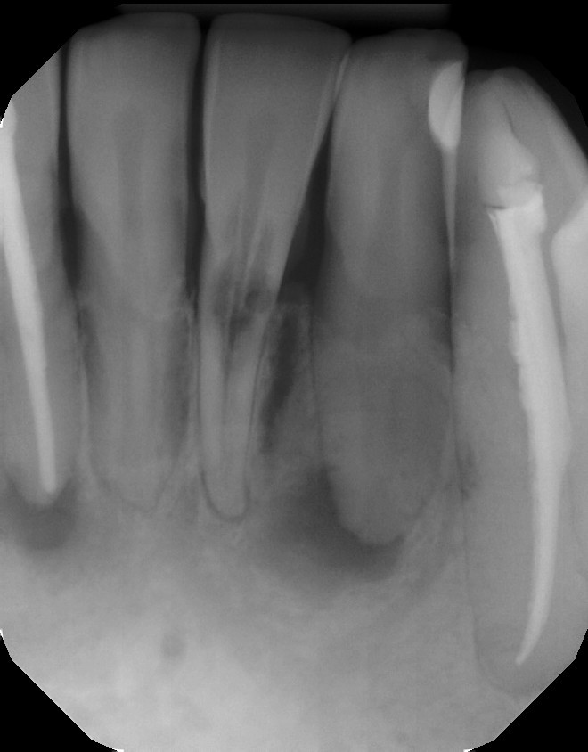 Dental X-ray showing dark irregular areas that indicate bone loss or tooth resorption