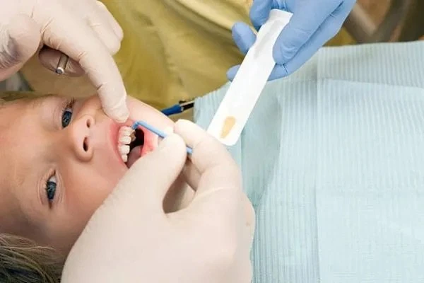 Fluoride varnish treatment