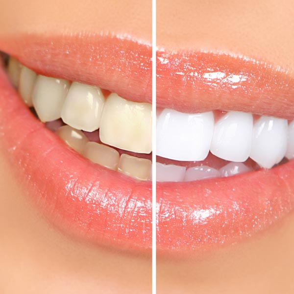 A bright white smile after professional teeth whitening