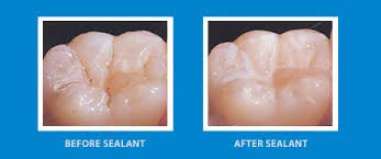 Dental sealants applied to molars