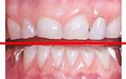 Wear on teeth caused by grinding