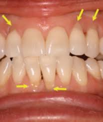 Receding gums caused by grinding