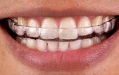 Traditional occlusal guard