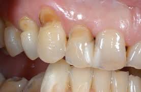 Abfraction damage at the gumline