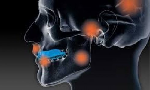 Mouthguards and concussion prevention