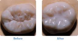 Tooth before and after a sealant is applied