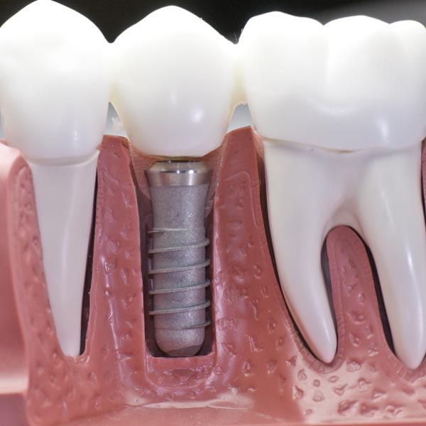 Illustration of a dental implant post set into the jaw