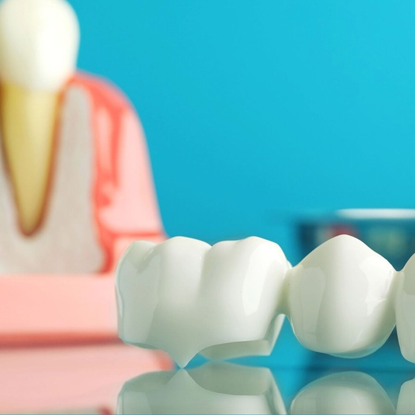 A dental bridge and crown model on a reflective surface