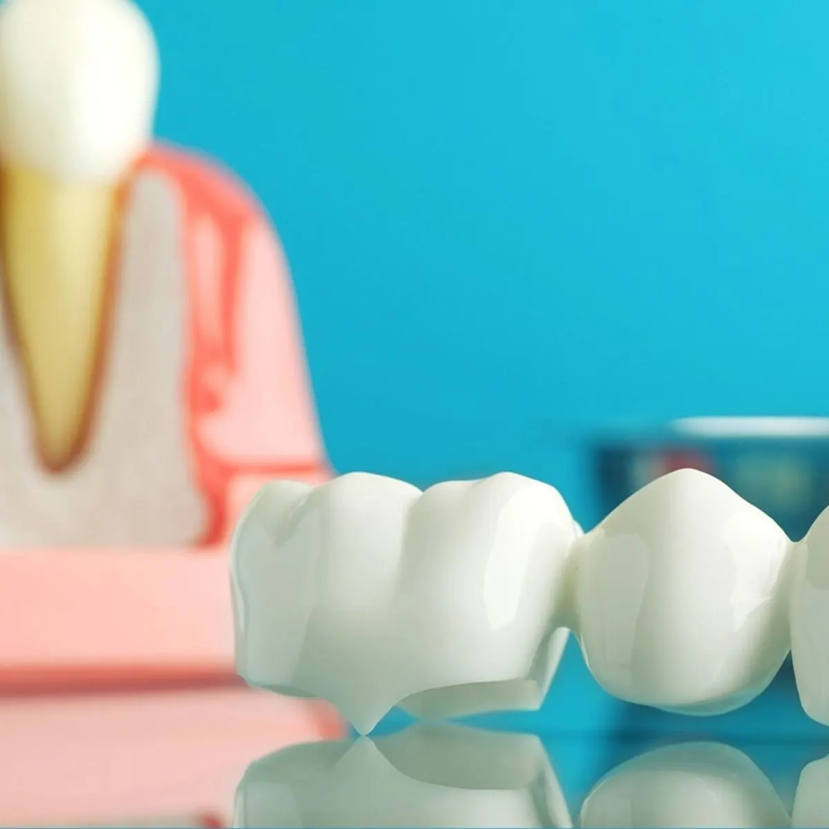 A dental bridge and crown model on a reflective surface